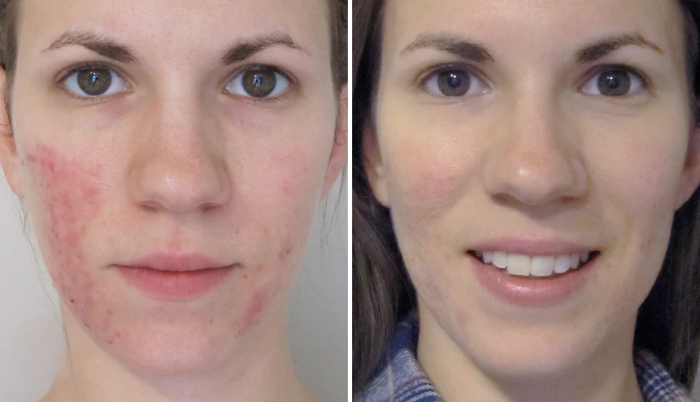 Mooibelle | Rosacea-corrector