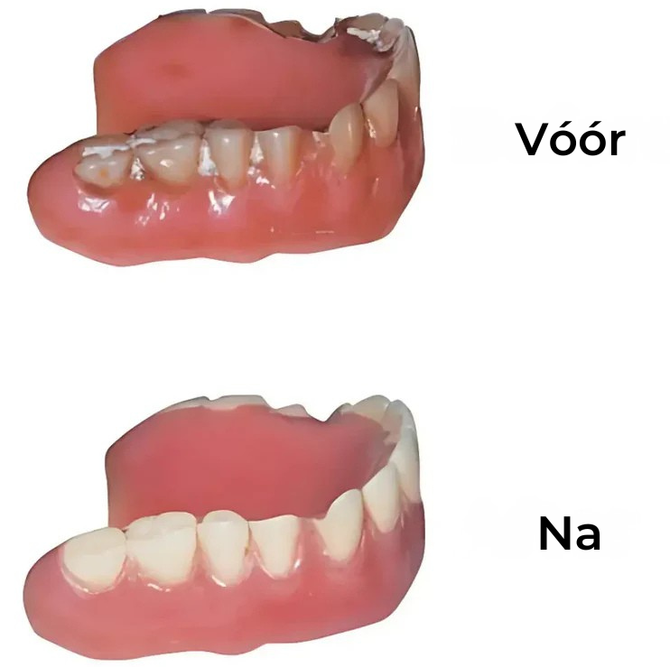 Mooibelle | Kunstgebitkoepel
