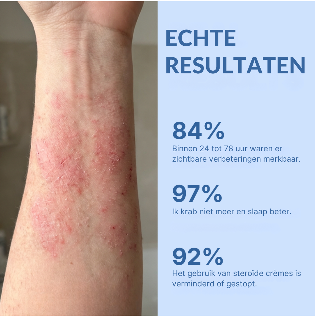 Mooibelle Crème tegen eczeem en psoriasis
