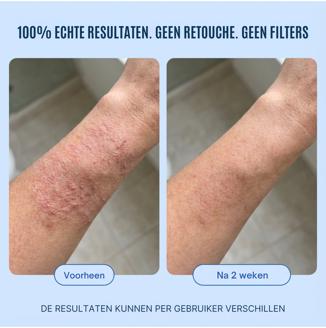 Mooibelle Crème tegen eczeem en psoriasis