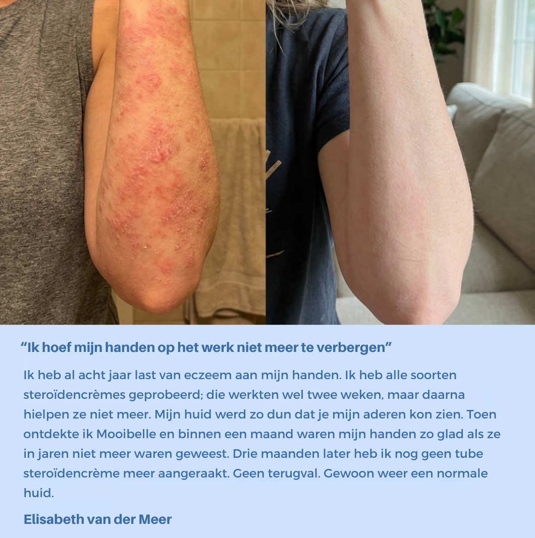 Mooibelle Crème tegen eczeem en psoriasis