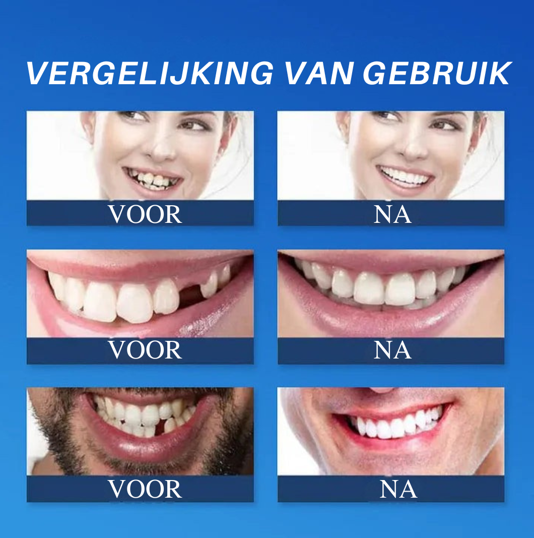 Mooibelle Medical Volledig kunstgebit met sterke hechting: op maat gemaakt, volledig functioneel kunstgebit