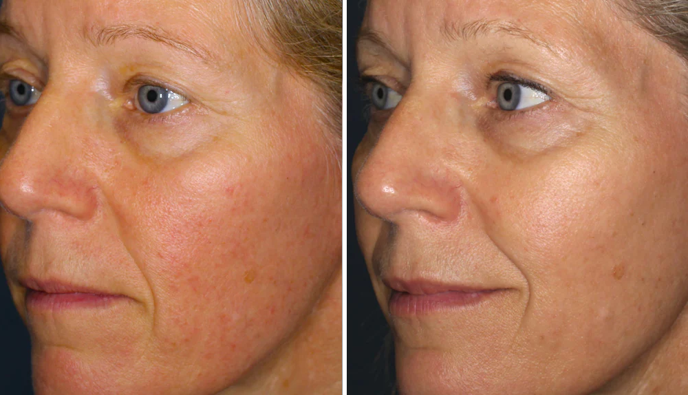 Mooibelle | Rosacea-corrector