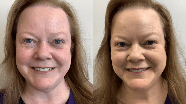 Mooibelle | Rosacea-corrector
